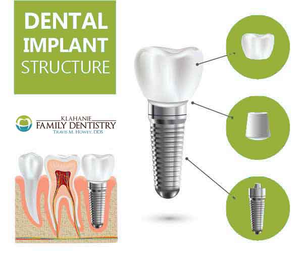 dental-implant-structure-titanium-post-abutment-crown