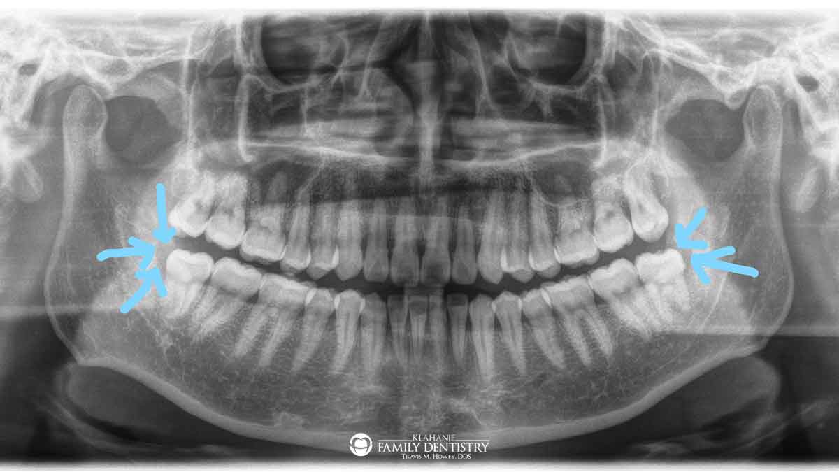 pericoronitis-CT-Scan-featured