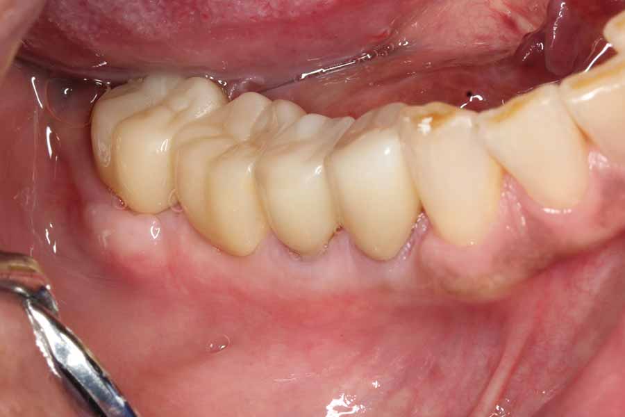 after-bridge-and-crown