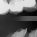 broken-dental-implant-ct-scan-featured