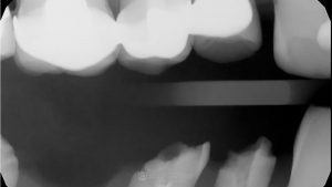 broken-dental-implant-ct-scan-featured