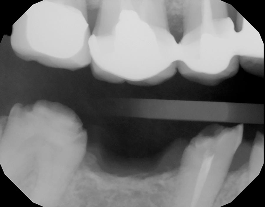broken-teeth-biologic-shaping-ct-scan-2