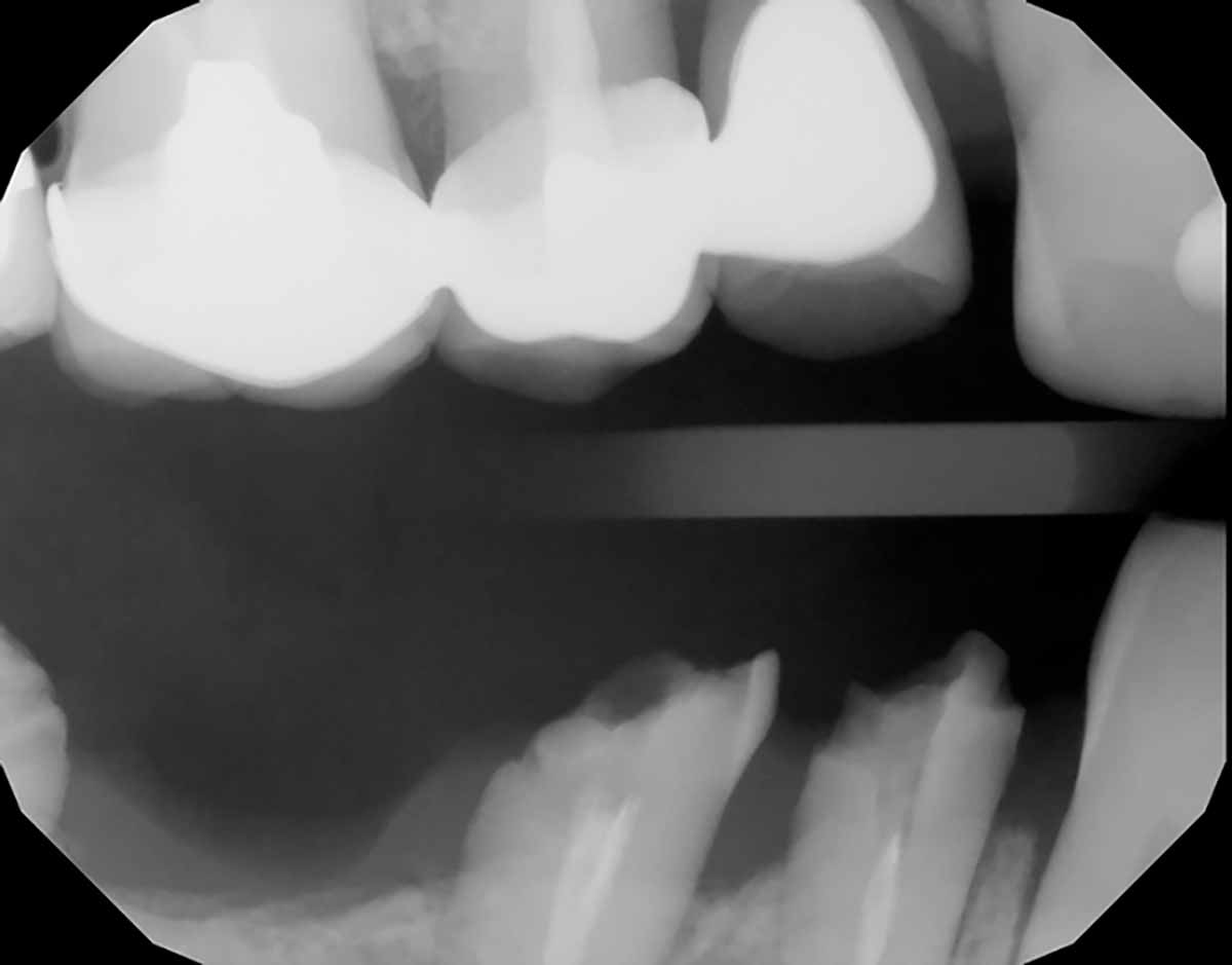 broken-teeth-biologic-shaping-ct-scan
