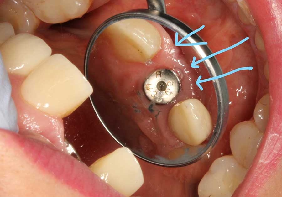 buccal-width-saved-socket-shield-arrows-indicating-issue