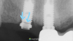 cracked-dental-implant-broken-tooth-arrows-indicating-break-ct-scan-featured