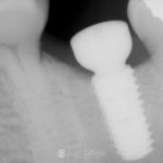 dental-implant-healing-featured