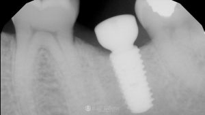 dental-implant-healing-featured