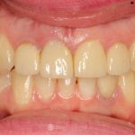 finished-healed-implant-placed-socket-shield-featured