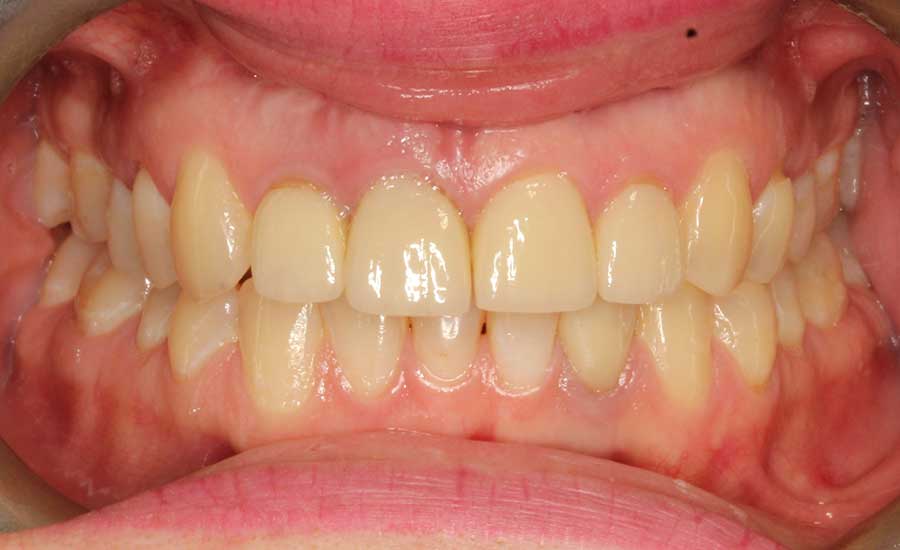 finished-healed-implant-placed
