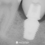 fractured-root-canal-tooth-after-dental-implant-featured