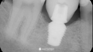fractured-root-canal-tooth-after-dental-implant-featured