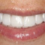 full-mouth-implants-after-featured