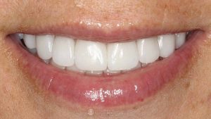 full-mouth-implants-after-featured