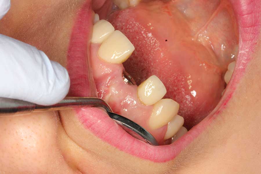 healing abutment