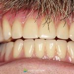 healing-dentures-all-on-x-after-featured