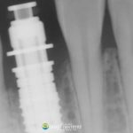 invasive-resorption-after-dental-implant-featured