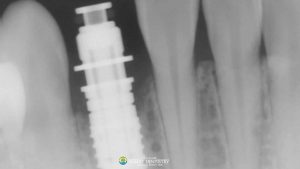 invasive-resorption-after-dental-implant-featured