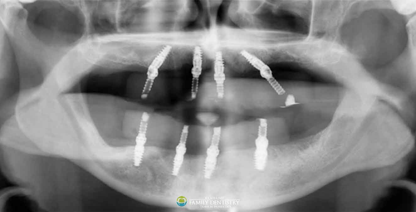 radiograph-all-on-x-1