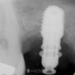 sinus-lift-implant-placement-featured