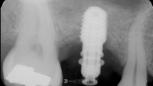 sinus-lift-implant-placement-featured