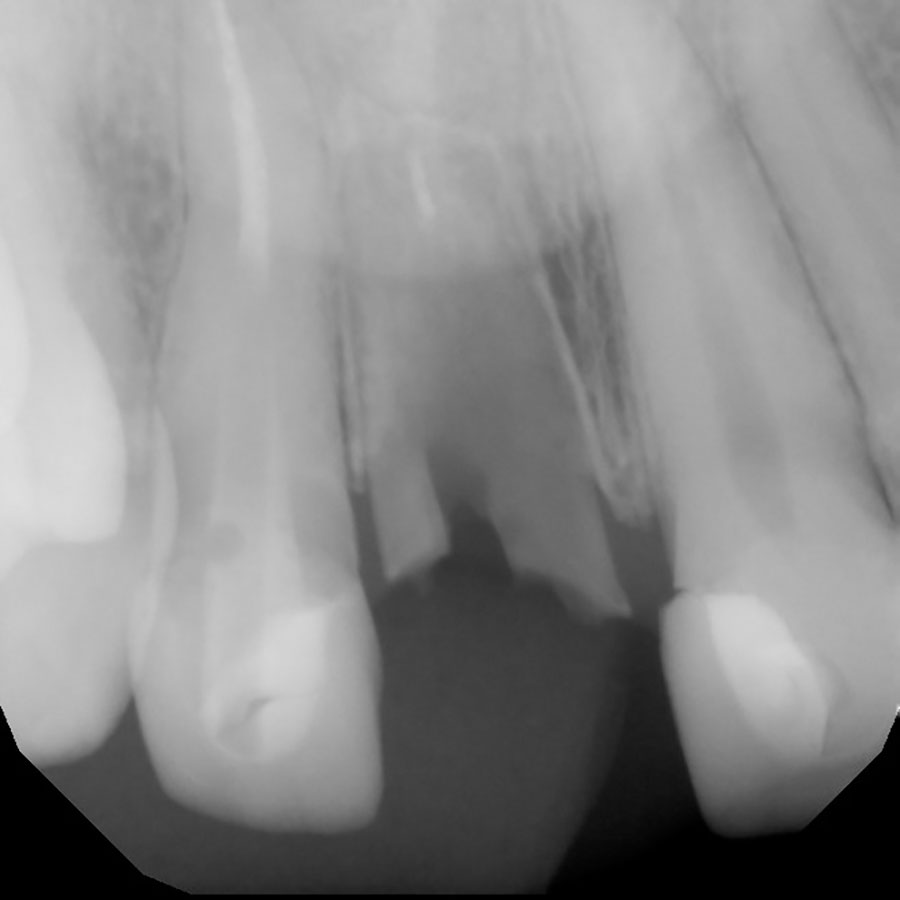 socket-shield-before-dental-implant-ct-scan