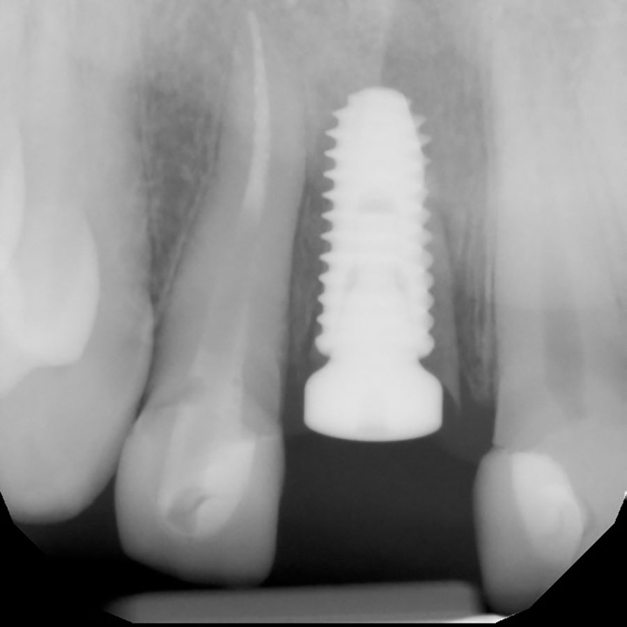 socket-shield-dental-implant-ct-scan