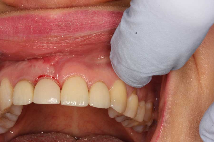 temp-stage-gingivectomy
