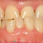 worn-teeth-featured