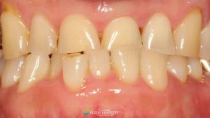 worn-teeth-featured